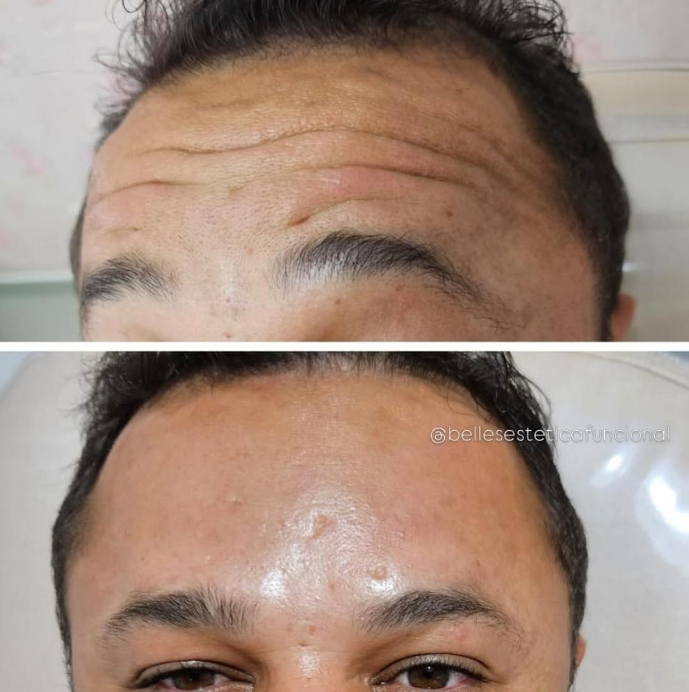 Botox