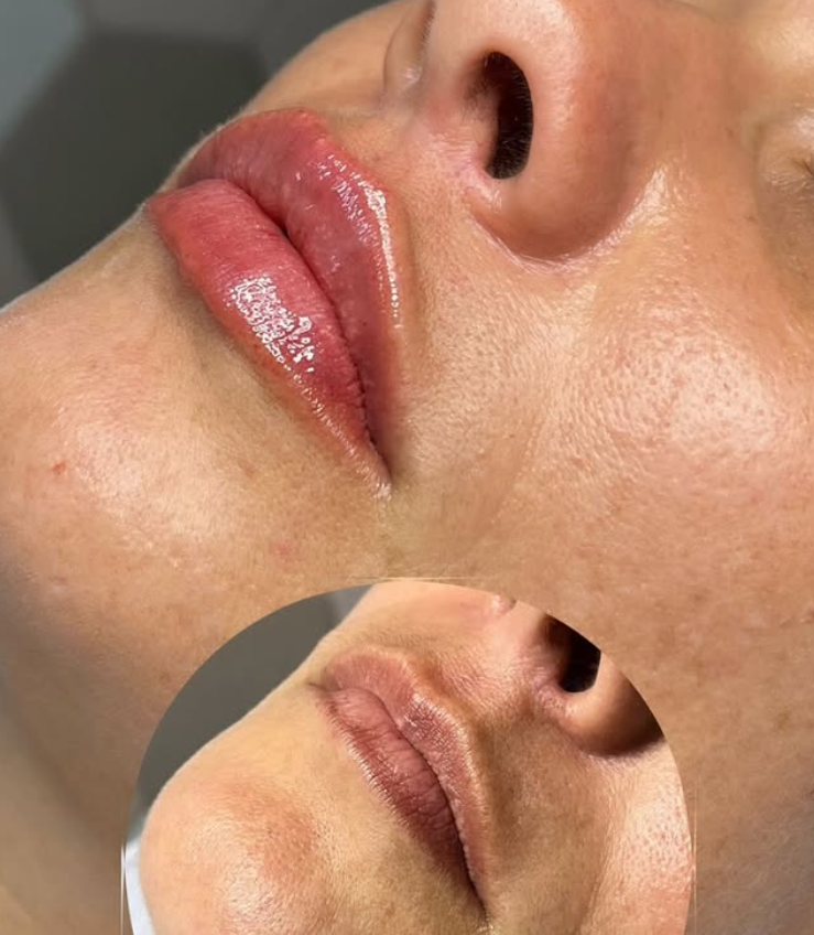 Preenchimento Labial