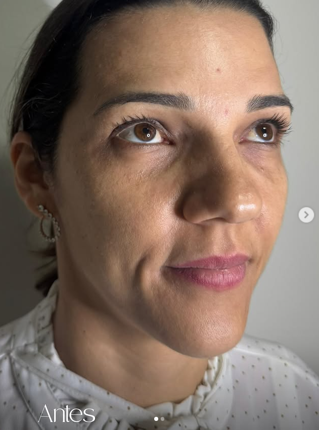 Resultado de tratamento facial