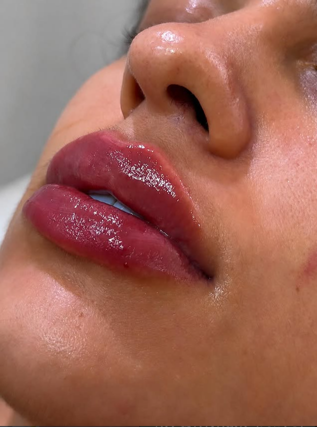 Resultado de preenchimento labial