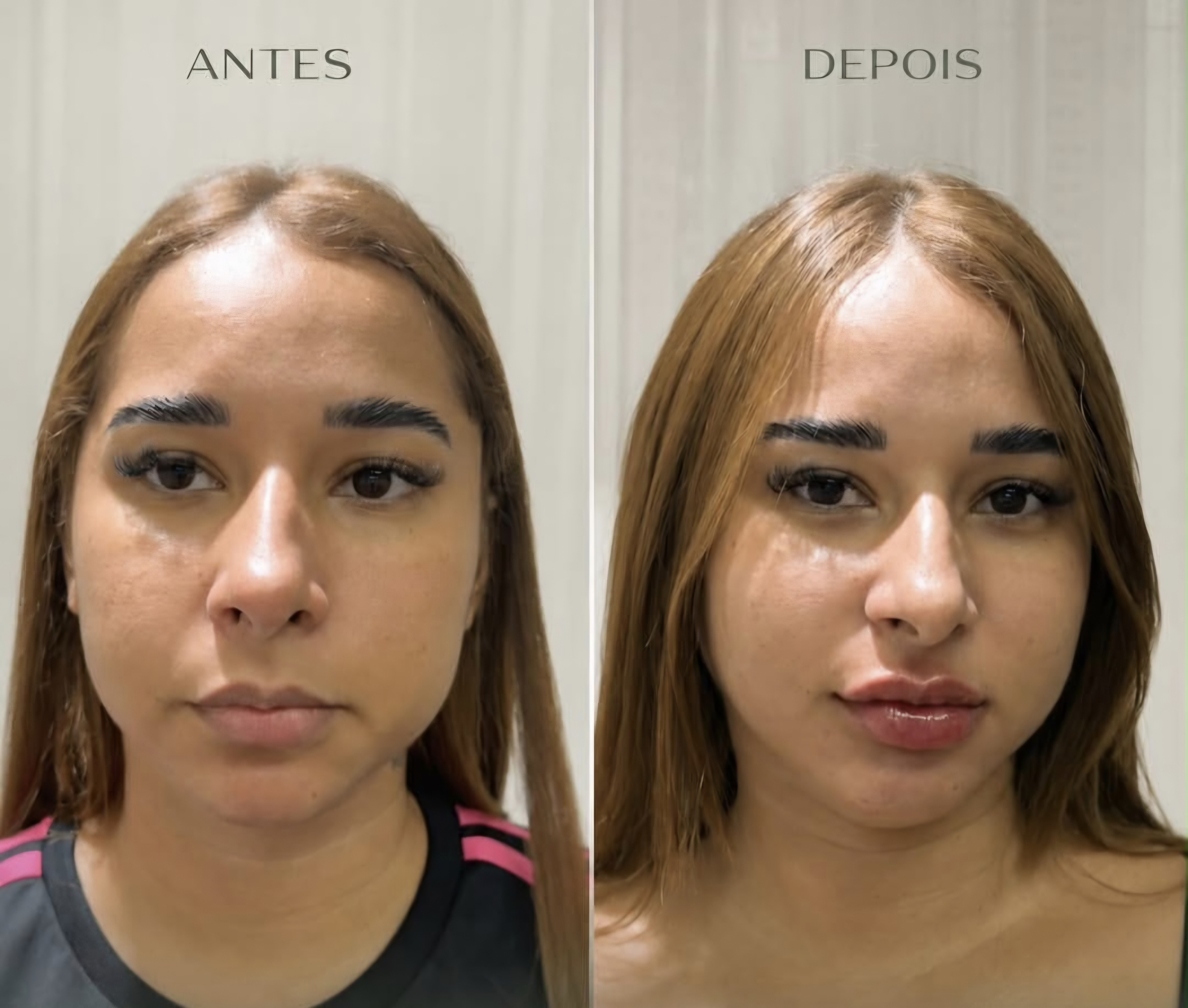 Harmonização Facial